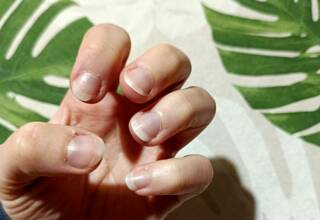 Come affrontare e sconfiggere l'onicofagia